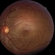 Left Eye- Posterior Segment Left Eye- Posterior Segment
