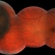 Retinal hyperplasia