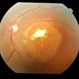 Heredomacular Degeneration