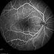 Retinal Dystrophy of 24-Year-Old Male/ Fluorescein Angiogram OD Retinal Dystrophy of 24-Year-Old Male/ Fluorescein Angiogram OD