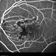 Macula Serpiginous Choroidopathy Macula Serpiginous Choroidopathy
