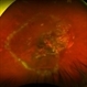 Diabetic Retinopathy Diabetic Retinopathy