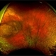 Regressing Choroidal Melanoma with Asteroid Hyalosis