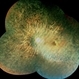 Retinitis pigmentosa Retinitis pigmentosa