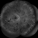 FFA in Atypical Tubercular Peripheral Occlusive Retinal Vasculitis