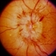Disc Edema