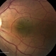 Papillomacular Fold in Posterior Microphthalmos