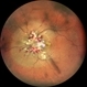 LE WIDEFIELD FUNDUS PHOTOGRAPH OF HYPERTENSIVE RETINOPATHY GRADE IV