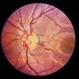Preretinal Vascular Loop Preretinal Vascular Loop
