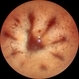Retinitis Pigmentosa with Macular Hole with Posterior Subcapsular Cataract Retinitis Pigmentosa with Macular Hole with Posterior Subcapsular Cataract