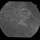 Adult Coats' Disease