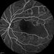 Idiopathic Occlusive Retinal Vasculitis (Late Stage) Idiopathic Occlusive Retinal Vasculitis (Late Stage)