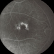 Pattern Dystrophy Pattern Dystrophy