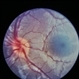 Combined Retinal / RPE Hamartoma Combined Retinal / RPE Hamartoma