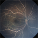 Lipemia Retinalis Lipemia Retinalis