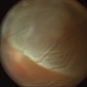 Bullous Rhegmatogenous Retinal Detachment Bullous Rhegmatogenous Retinal Detachment
