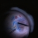 Macular Hole With Folded ILM Macular Hole With Folded ILM