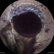 VALSALVA RETINOPATHY
