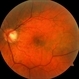 Epiretinal Membrane Epiretinal Membrane