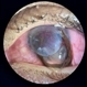 Expulsion of Retina