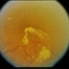 BDR / Macular Edema / Macroaneurysm BDR / Macular Edema / Macroaneurysm