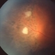 Eales Disease