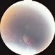 Retinoblastoma