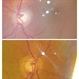 Glaucomatous optic disc Glaucomatous optic disc