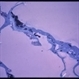 Pigmented Pre-retinal Membrane Pigmented Pre-retinal Membrane