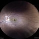 Myopic Subretinal Neovascular Membrane