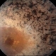 Retinitis Pigmentosa With Macular Involvment Retinitis Pigmentosa With Macular Involvment