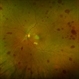 Roth Spots in Acute Myeloid Leukemia Roth Spots in Acute Myeloid Leukemia