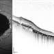 Geographic Atrophy 2nd to Central areolar choroidal dystrophy Geographic Atrophy 2nd to Central areolar choroidal dystrophy