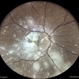 Multifocal Chorioretinitis