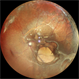 Retinal Detachment Under Silicon Oil