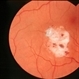 Cavernous Hem of Retina Cavernous Hem of Retina