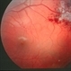 Cavernous Hem of Retina Cavernous Hem of Retina