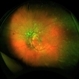Hypertensive retinopathy, left Hypertensive retinopathy, left