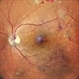 Proliferative Diabetic Retinopathy Proliferative Diabetic Retinopathy