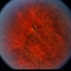Multiple Sclerosis