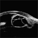 Idiopathic Iris Cyst Idiopathic Iris Cyst