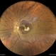 Subretinal Neovascular Membrane