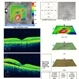 Choroidal Osteoma Choroidal Osteoma