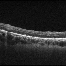 Acute Syphilitic Posterior Placoid Chorioretinopathy - Retina Image Bank