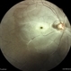 Central Retinal Artery Occlusion Central Retinal Artery Occlusion