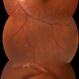 Dislocated Intraocular Lens (IOL)