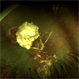 Retinal Detachment After Retinoblastoma Treatment