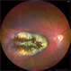 Presumed Congenital Toxoplasmosis