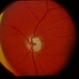 Sturge-Weber / Choroidal Hemangioma Sturge-Weber / Choroidal Hemangioma