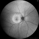 Posterior Placoid Chorioretinitis Posterior Placoid Chorioretinitis